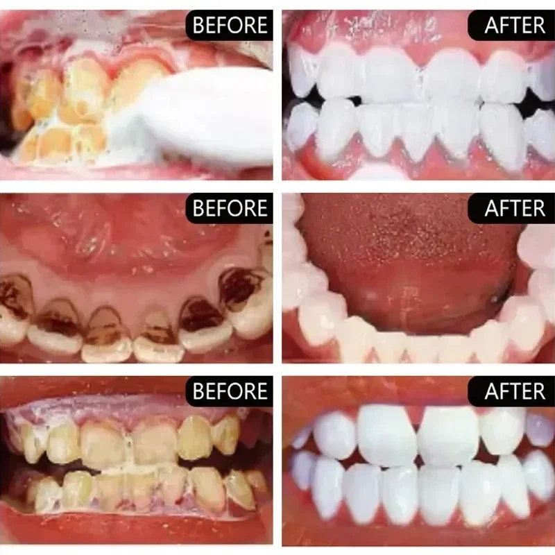 Cepat Menghilangkan Noda Asap  - Teeth Whitening Fast ulasan dan harga