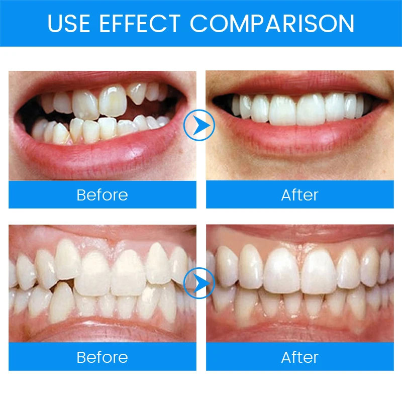3 Tahap Kawat Gigi Ortodontik  - Teeth Whitening Mouth Guard ulasan dan harga